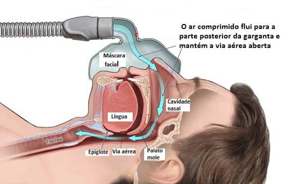 Desmistificando o CPAP