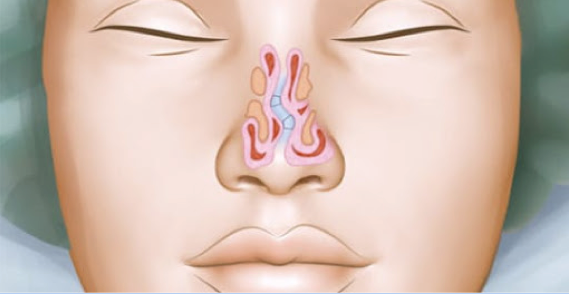 Recuperação Pós Cirurgia Nasal: quais os cuidados?