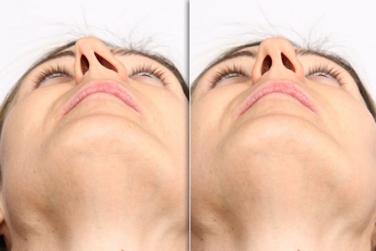 Antes e depois de uma cirurgia de desvio de septo, mostrando a melhora na simetria e no fluxo nasal.