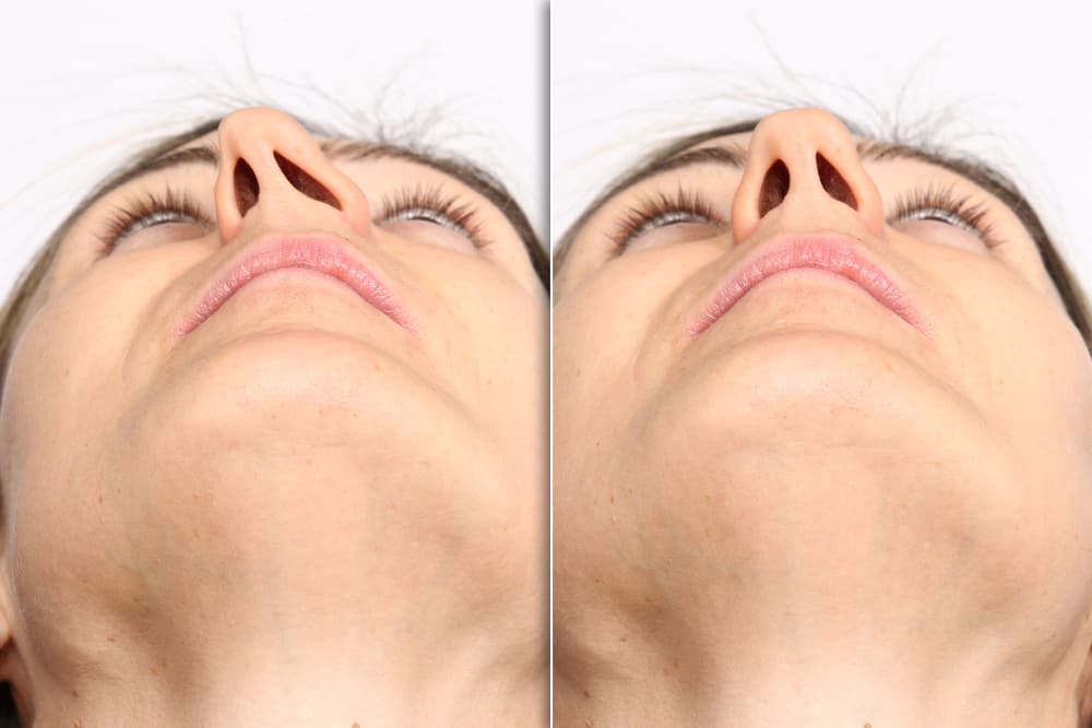 Cirurgia de desvio de septo: tudo o que você precisa saber!
