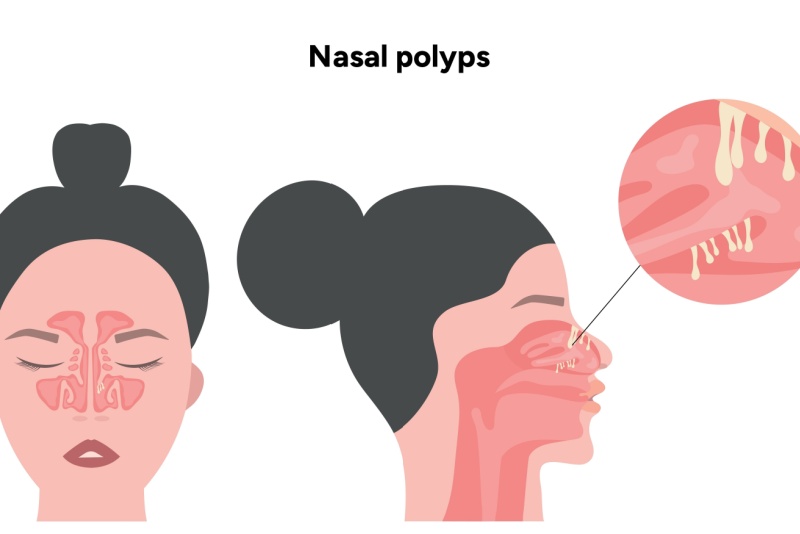 Cirurgia de pólipos nasais: quando é indicada, como funciona e recuperação