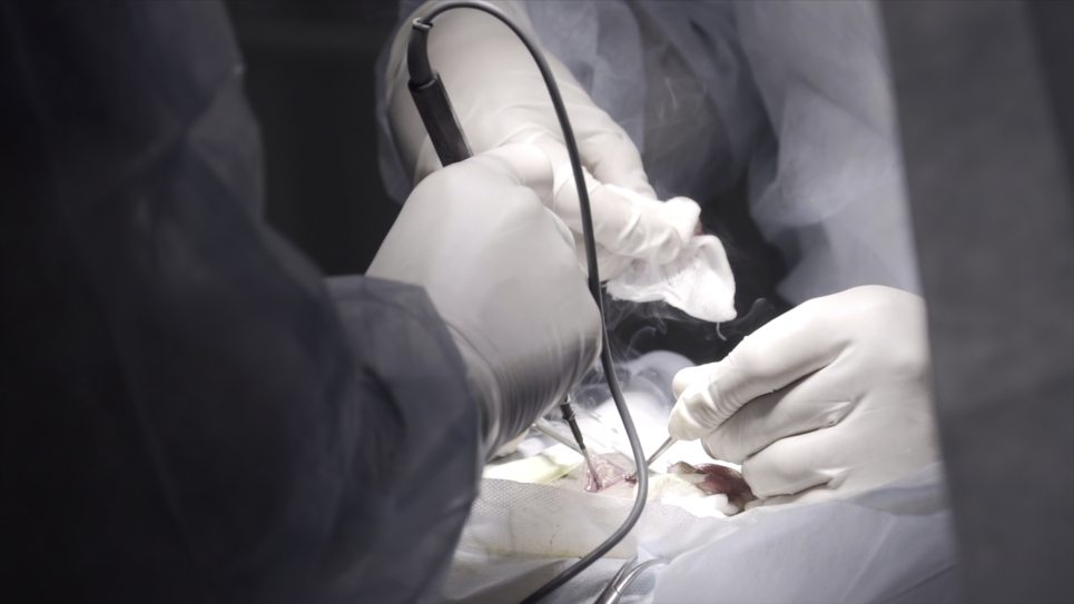 Amigdalectomia intracapsular com Coblation